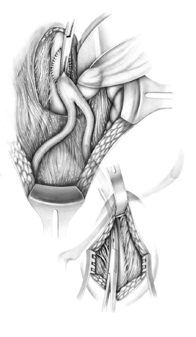 ABFBG Technical