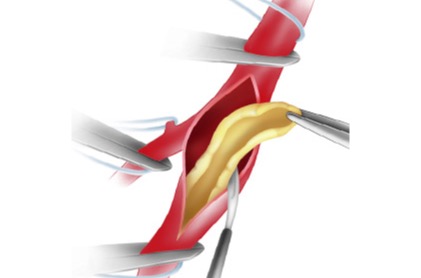 Endarterectomy